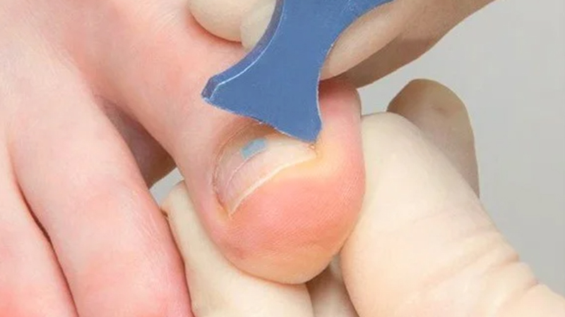Cách xử lý móng chân mọc ngược tại tiệm nail